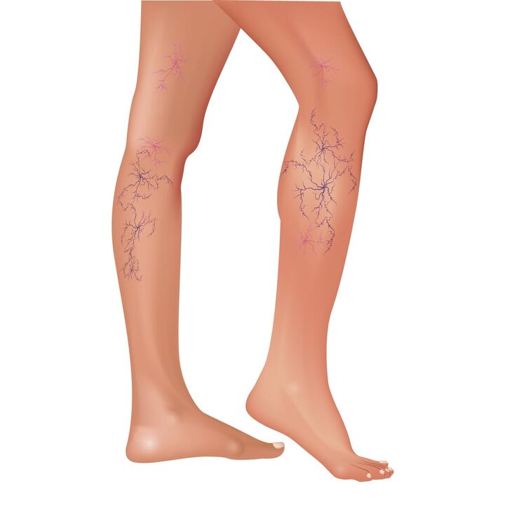 Vena varicose veins