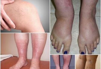 Photos of varicose vein manifestations on the legs
