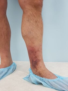 Complications of varicose veins in men