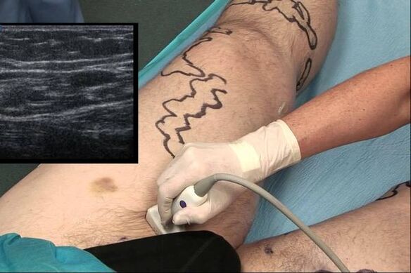 Diagnosis of varicose veins in men