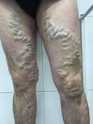 Neglected male varicose veins