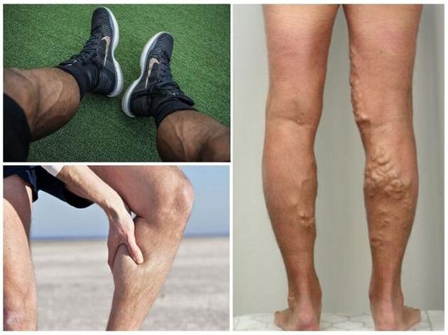 What do varicose veins look like on men's legs