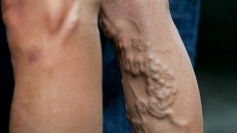 Manifestations of enlarged varicose veins of the lower extremities
