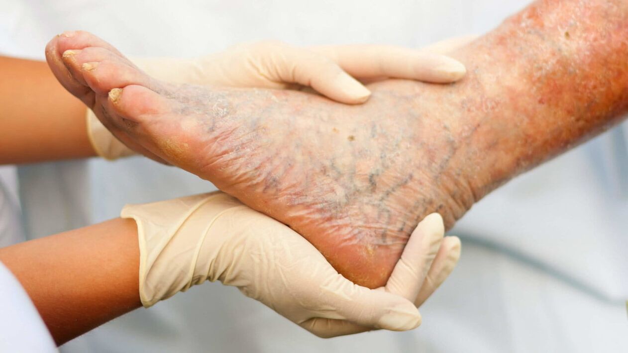 Phlebologist refers to the treatment of varicose veins in the legs