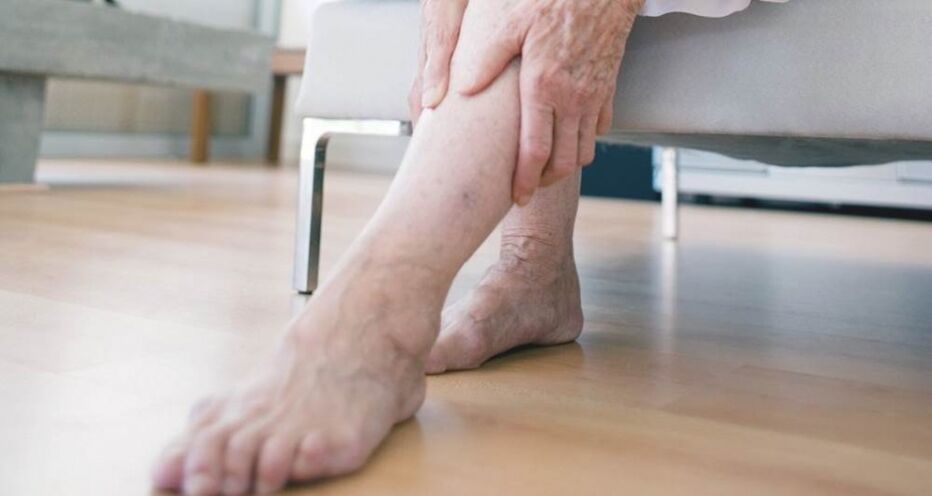 Varicose veins of the lower extremities caused by venous valve dysfunction