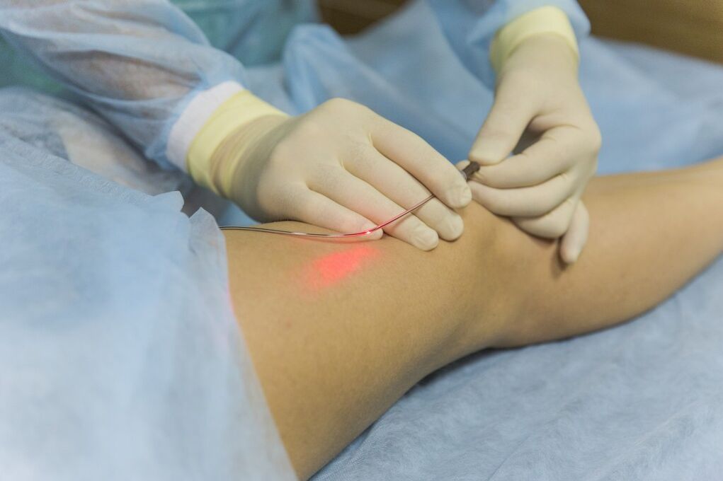 Laser treatment of varicose veins of lower limbs