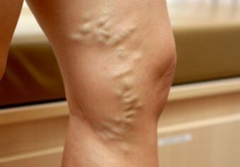 Variegated veins on female legs