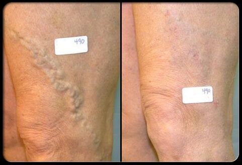 Before and after surgery