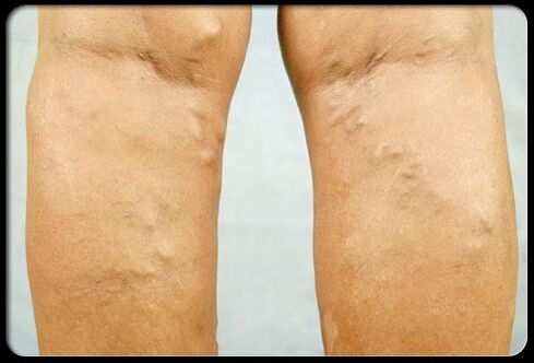 Varicose veins on the legs