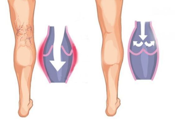 What are the varicose veins
